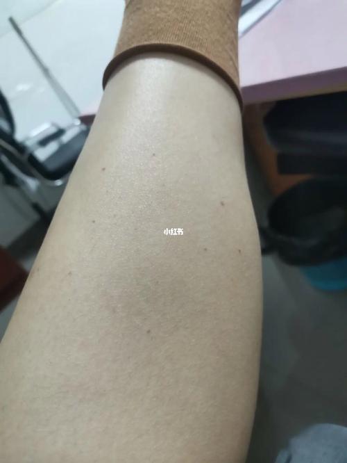 膝盖上出行紫斑,膝盖有紫斑-第6张图片-微云百科 膝盖上出行紫斑,膝盖有紫斑-第6张图片-微云百科